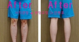  사지연장후 부작용을 줄이기 위한 재활운동법