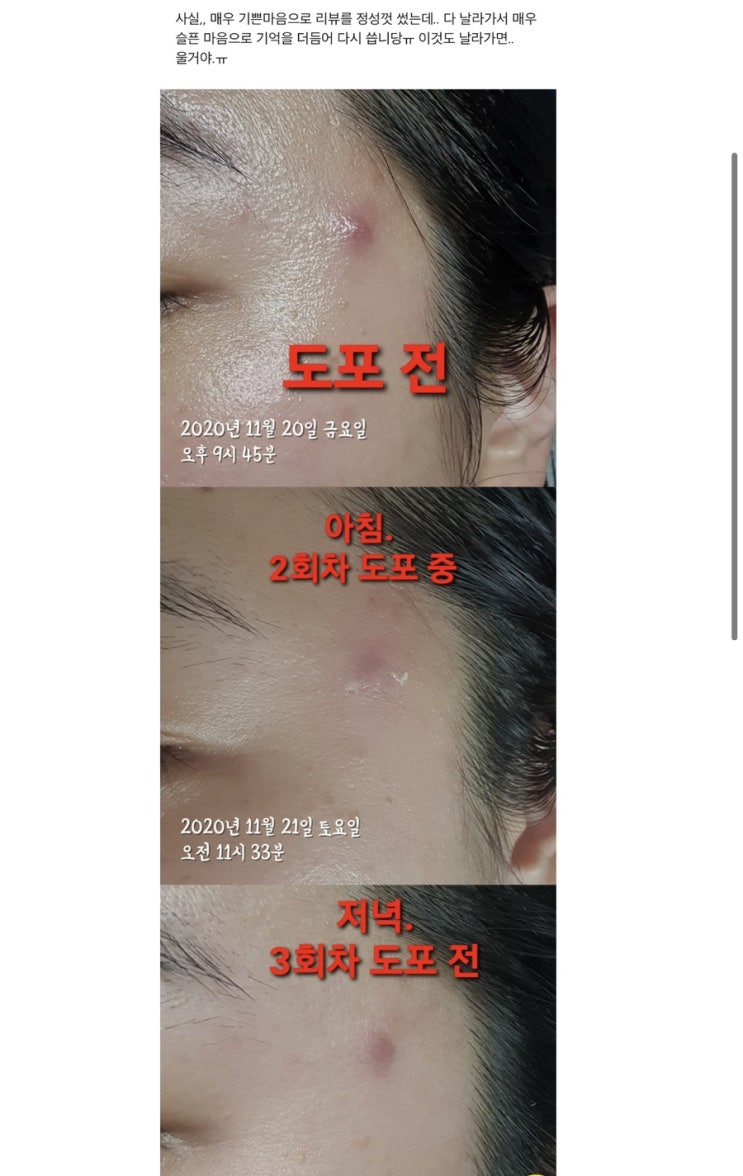 트러블 비상템 ! 트러블 직빵 ! 제플 리얼 후기  이제품도 현재  품절 직전 ㅠㅠ