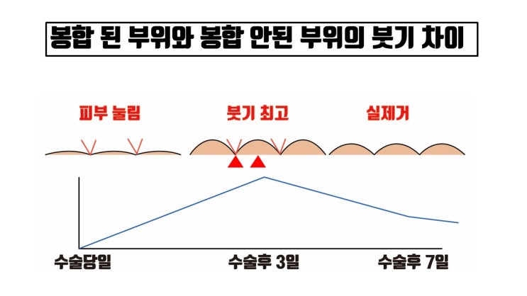  앞트임 실밥제거 후 앞트임 흉터가 울퉁불퉁해요 ㅠㅠ