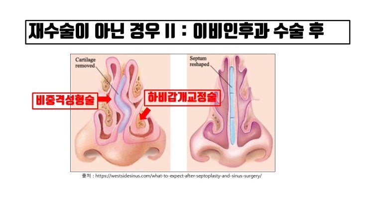  코재수술인지 확인하고 반드시 코수술비용 절약하세요!!!