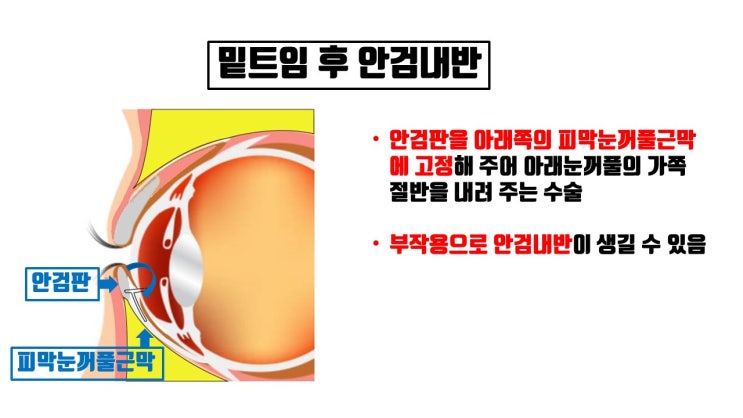 안검내반, 안검외반은 정말로 드문 눈밑트임 부작용
