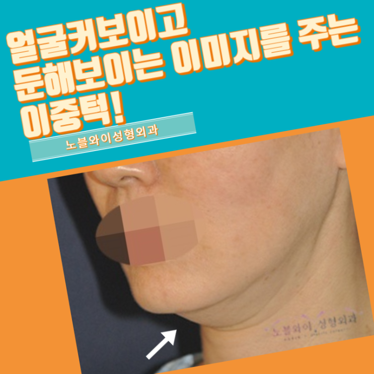  턱라인지방흡입 과연 유지기간 길까