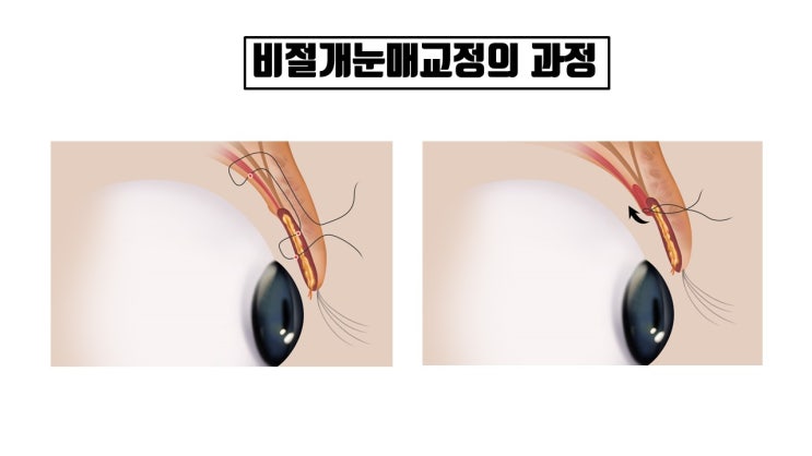  20대 30대 가성비갑 눈성형은 단연코 비절개눈매교정