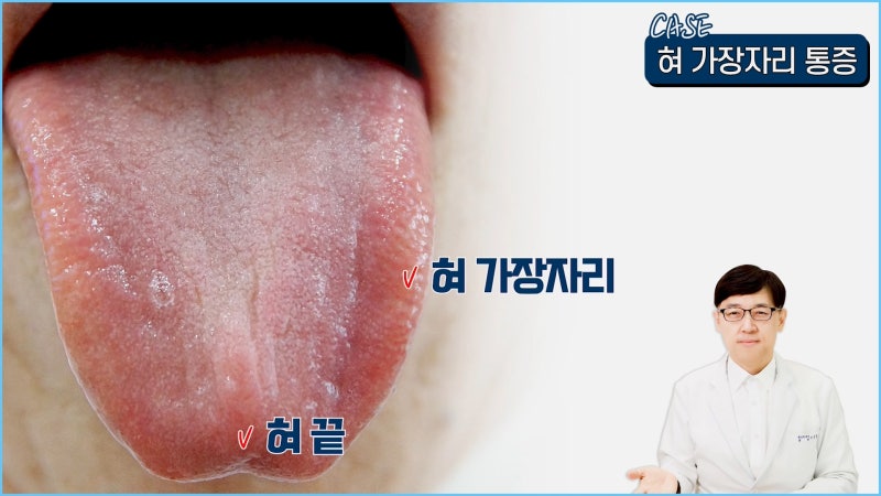 혀 옆에 올록볼록 뭐가 나서 아파요. 혀 가장자리 통증 원인은? : 네이버 블로그