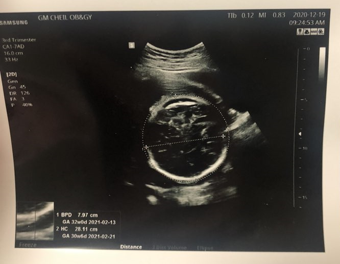 [임신일기] 임신 32주 배뭉침 태아몸무게 배둘레 작은 아이 + 피검사 초음파 기록