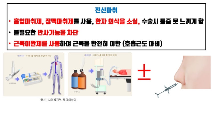  국소마취, 수면마취, 전신마취로 모두 가능한 코성형 마취
