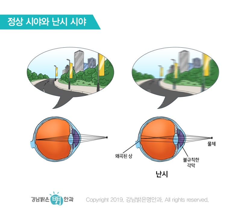 고도근시의 통증 및 회복기간 감소 및 안정