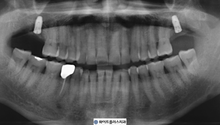 신길동 신길뉴타운 치과, 뼈가  약한 상악 제2대구치 임플란트 식립