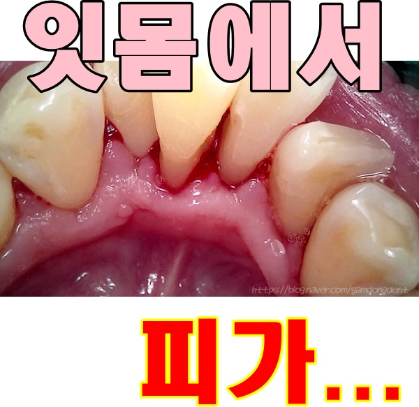  당감동치과 피나는잇몸 치료방법