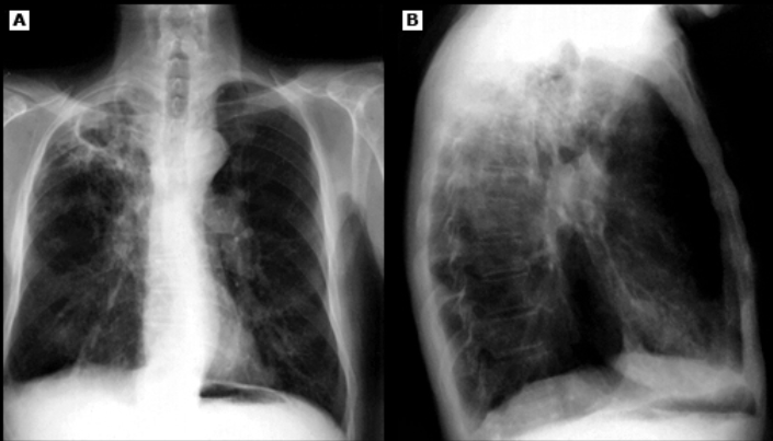 재활성 폐결핵, Reactivation tuberculosis : 네이버 블로그