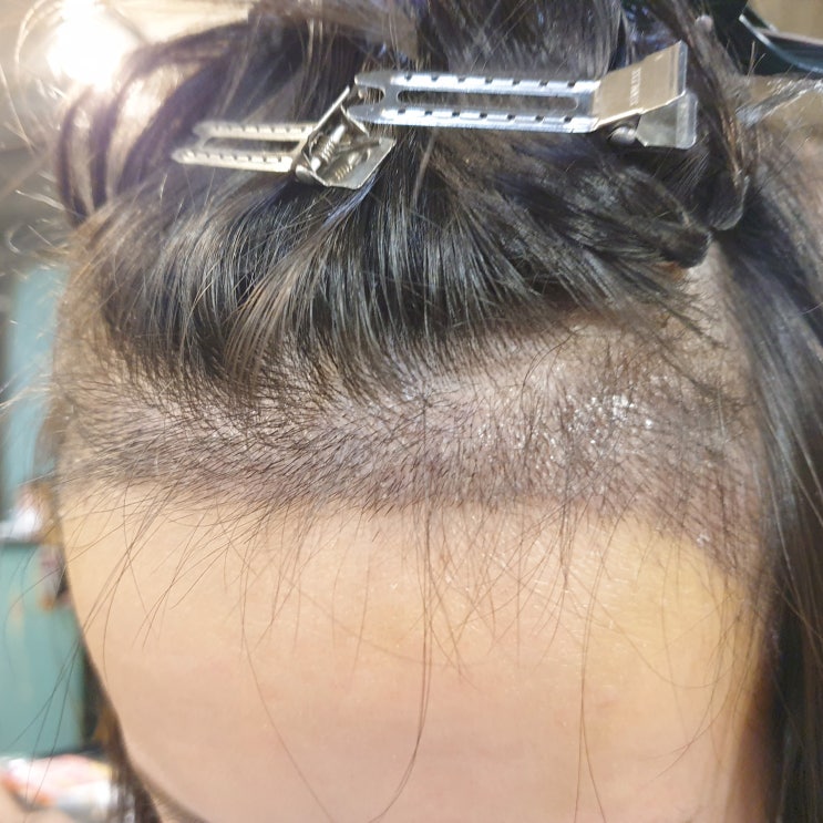  여자 m자 이마 수술 후 뒷머리카락 증모술