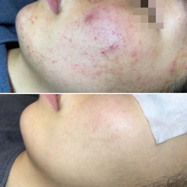  지루피부염관리,지루성피부염관리,문제성피부관리잘하는곳