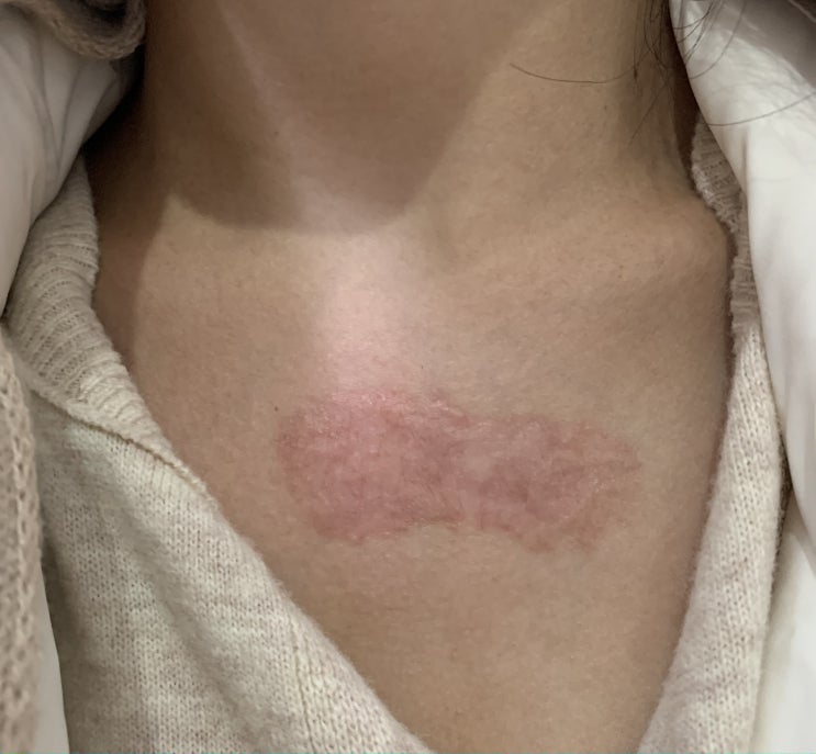  나의 켈로이드 (keloid) 치료 일기 / 6개월 치료 목표 12-1 (21.01.05 당일)