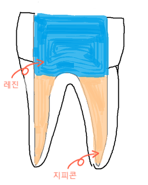  치아 신경치료 과정 8편 : 빈 공간 충전하기2 (치과이야기)