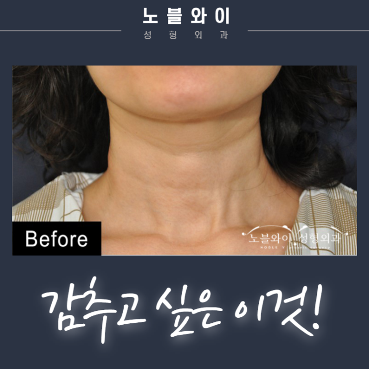  목주름제거술 진작에 할껄