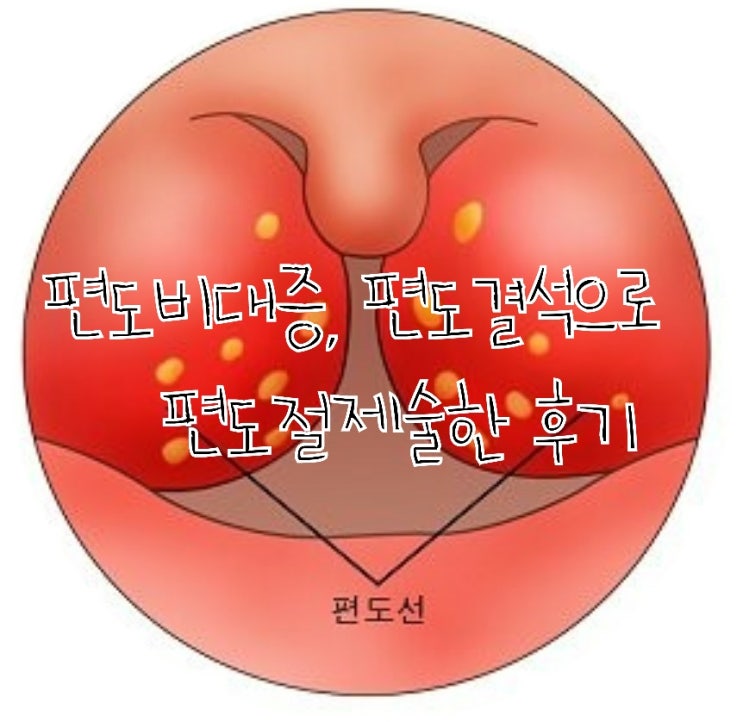  편도비대증과 편도결석으로 인해 편도절제술한 후기!!