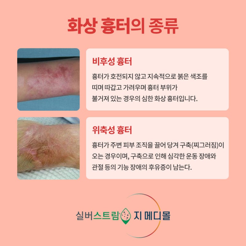 3도 화상 흉터 관리(정말 한 번도 안 되지만)는 계속 노력해야 할 것 같다. 6