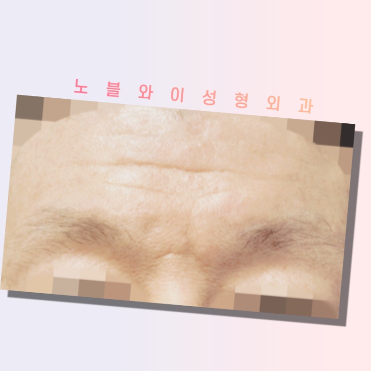  이마주름성형 주름개선과 눈매가 선명해졌다