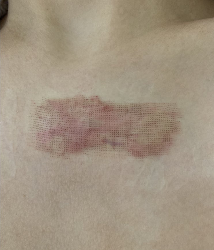 나의 켈로이드(keloid) 치료 일기 / 6개월 치료 목표 12-1 (2일차-3일차)