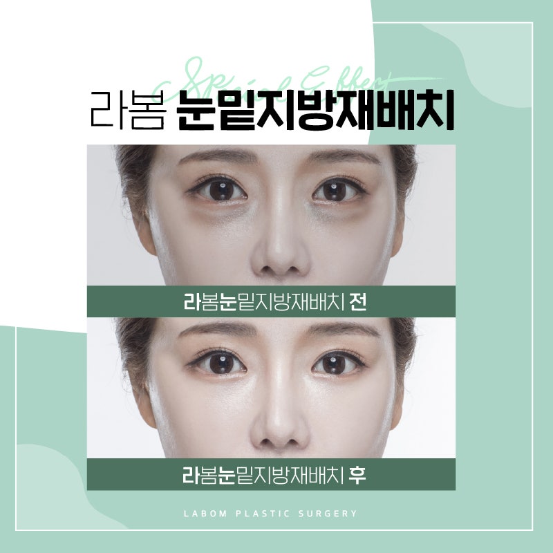 눈밑지방재배치잘하는곳 라봄에서! : 네이버 블로그