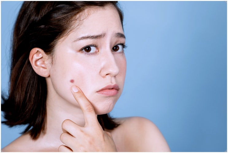  해운대여드름치료? 시간과 돈 날리는 환자들 특징