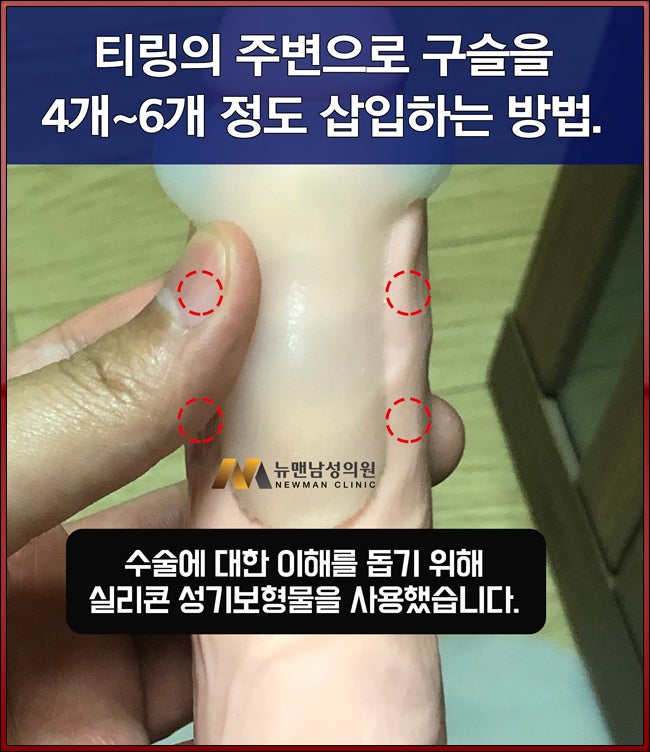 성기구슬, 주로 어떤 분들이 많이 할까? 효과는? : 네이버 블로그