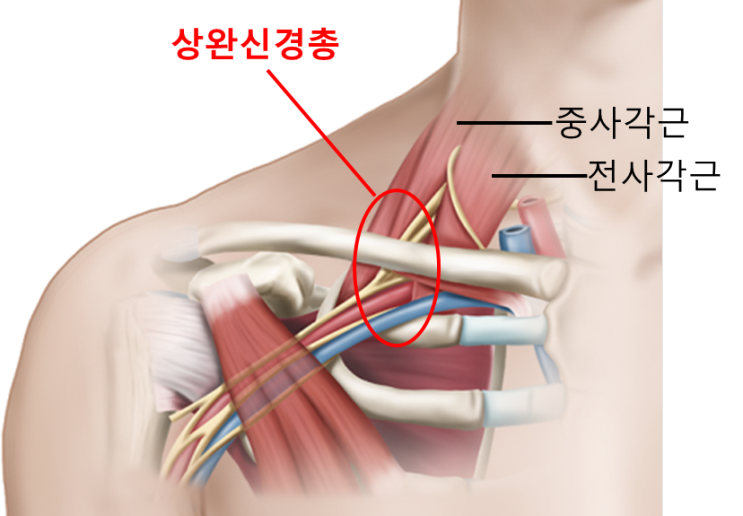 일산, 사각근 (2부) - 팔저림을 유발하는 여러 원인들 - 가로세로한의원 일산점