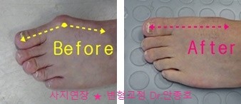  무지외반증수술의 진실