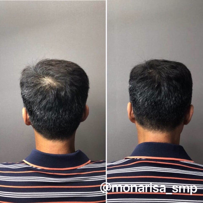 부산정수리에서 탈모증 초기증상 예방법을 미리 알아보세요!!++&&