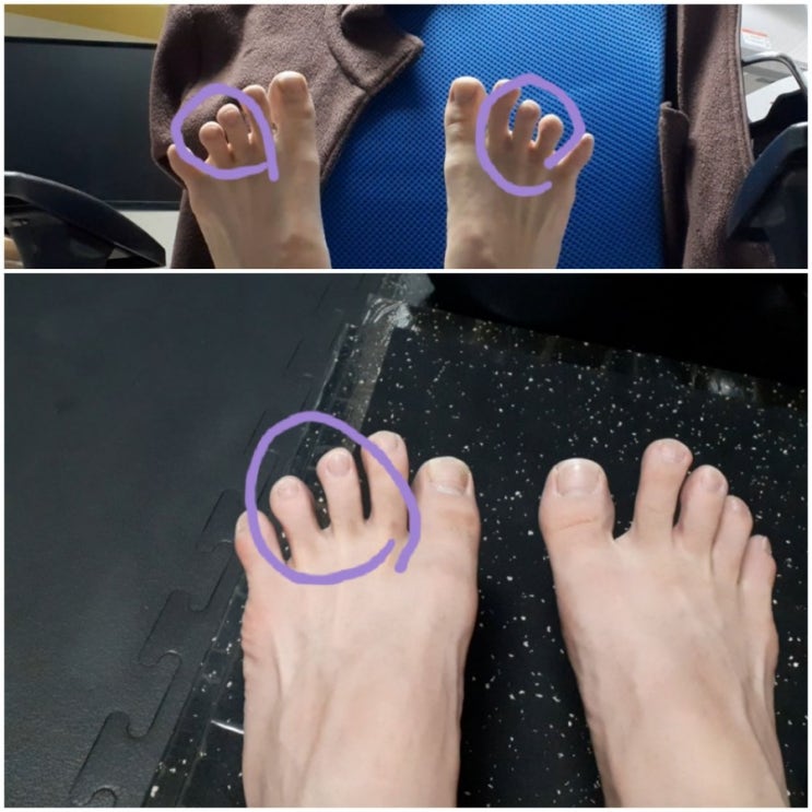 네번째 <b>발가락</b>, 드디어 움직인다 / 노력함. 그리고 <b>발가락</b>에... 