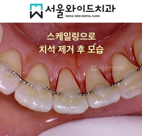 교정 후 고정식 유지장치 떨어짐, 재부착에 대해 - 유지 철사 제거는 언제? : 네이버 블로그 교정 후 고정식 유지장치 떨어짐, 재부착에 대해 - 유지 철사 제거는 언제? : 네이버 블로그