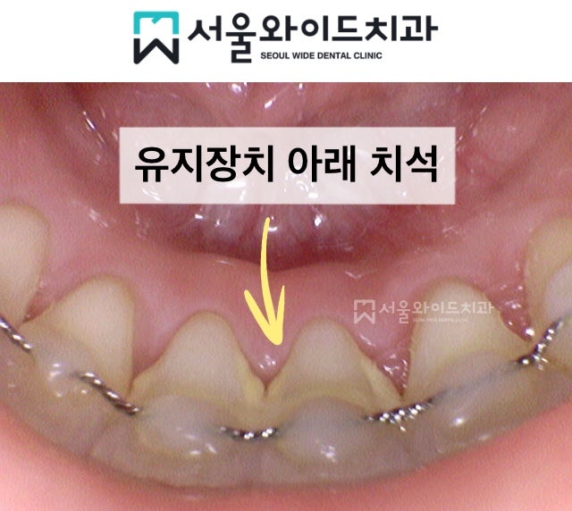 교정 후 고정식 유지장치 떨어짐, 재부착에 대해 - 유지 철사 제거는 언제? : 네이버 블로그 교정 후 고정식 유지장치 떨어짐, 재부착에 대해 - 유지 철사 제거는 언제? : 네이버 블로그