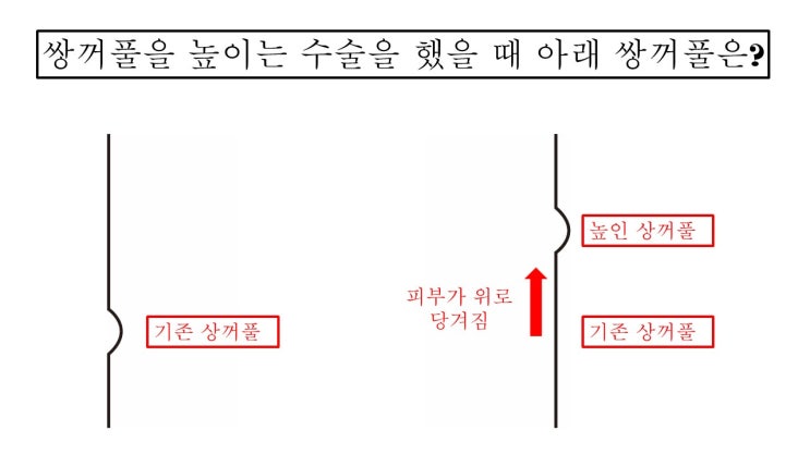  쌍수 라인 높이면 기존의 쌍꺼풀은 확실히 풀리나요?