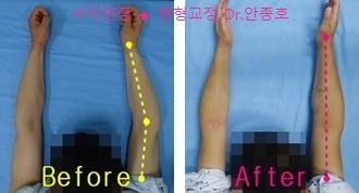  빨리 회복하는 내반주 수술후기