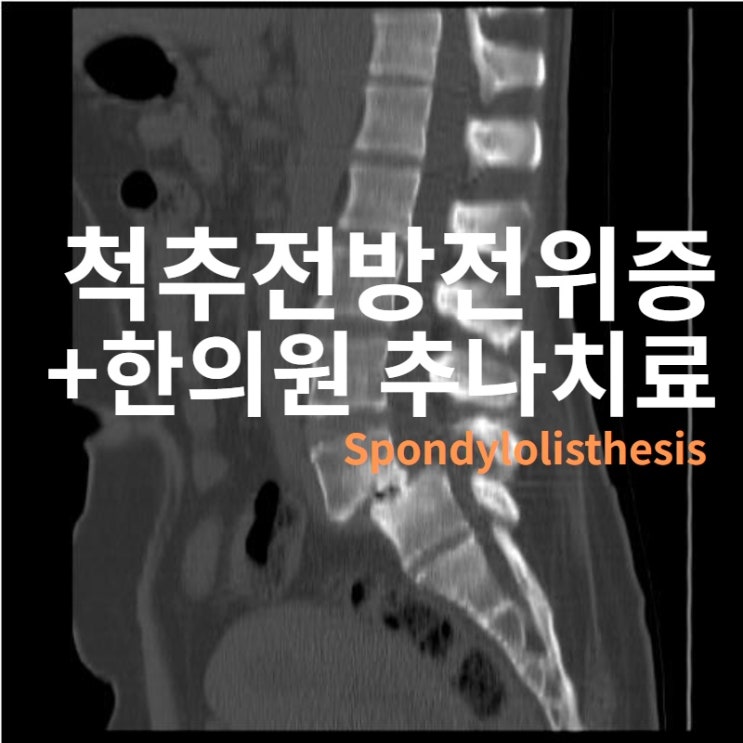  척추전방전위증 한의원 추나 치료의 효과!
