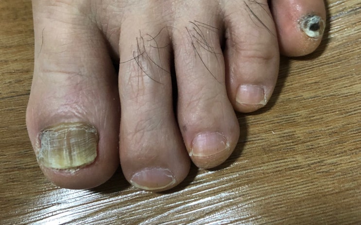  부모님 무좀발톱, 스케일링으로 무좀균박멸 #발톱스케일링 [1탄]