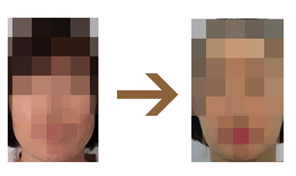  심부볼 처짐 사탕을 문 것 같다면