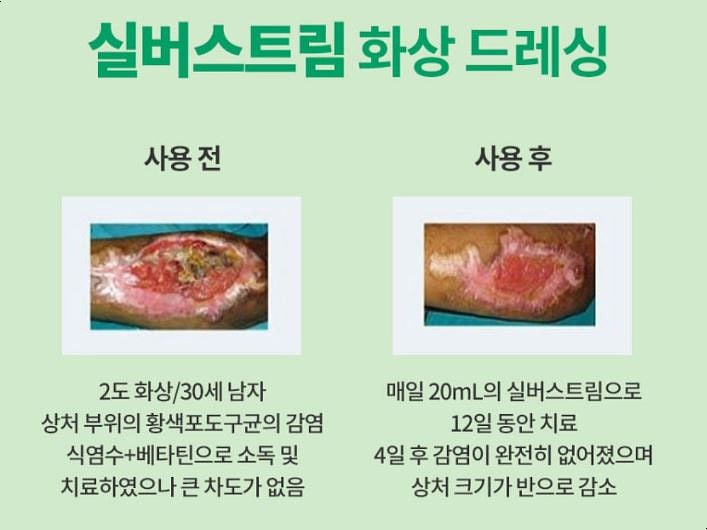 3도 화상 - 넓은 부위 증증 화상 진단, 치료 방법, 증상 사진 : 네이버 블로그