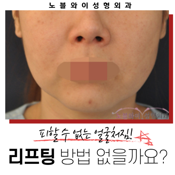  안면거상술잘하는병원 효과 제대로