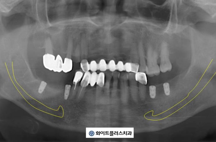  보라매 임플란트 치과, 개인 맞춤 임플란트 진단부터 치료까지