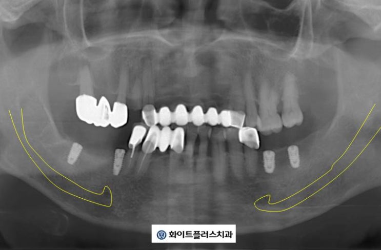 보라매 임플란트 치과, 개인 맞춤 임플란트 진단부터 치료까지