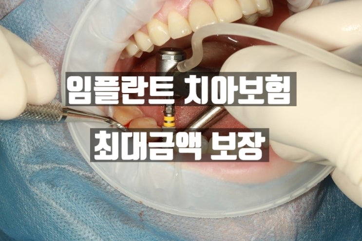  40대 성인 치아보험 임플란트 보장 편