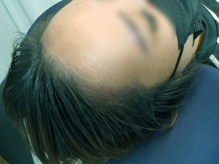  양산헤어라인 자꾸만 보게돼