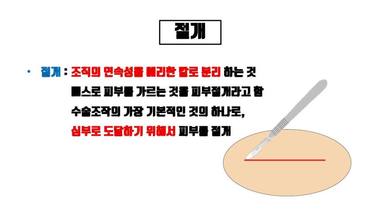  절개 쌍꺼풀로 절대로 위눈꺼풀 처짐 해결 못 해요!!!!