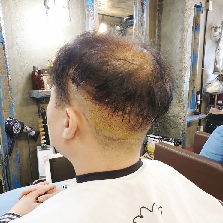  머리카락이식 투블럭 커트만이 정답일까?
