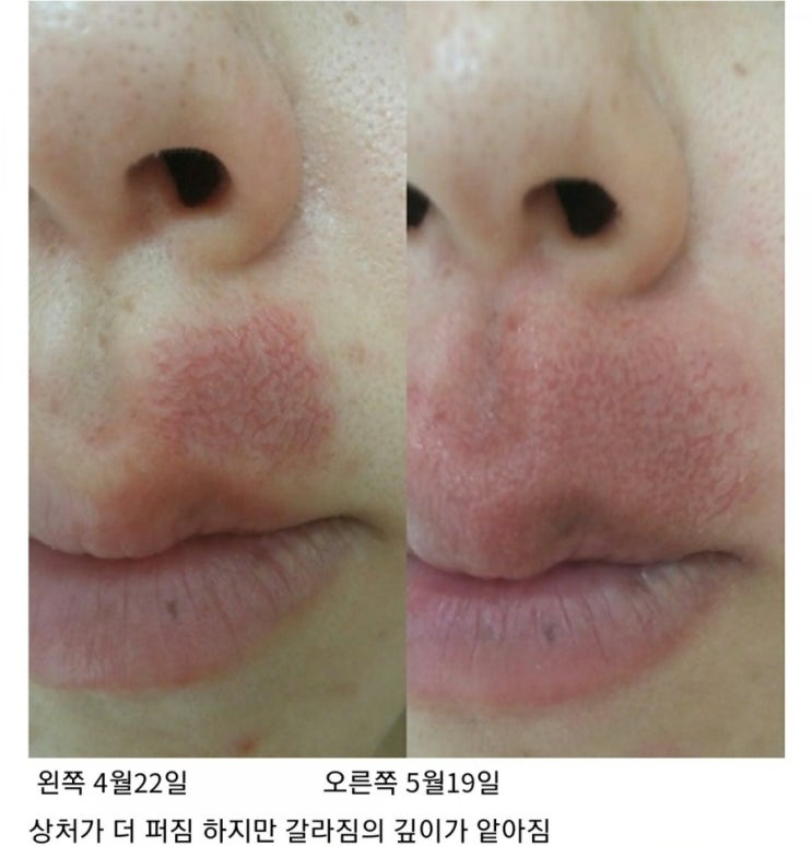  항생제부작용 피부발진으로 나타났을 때 관리하는 방법