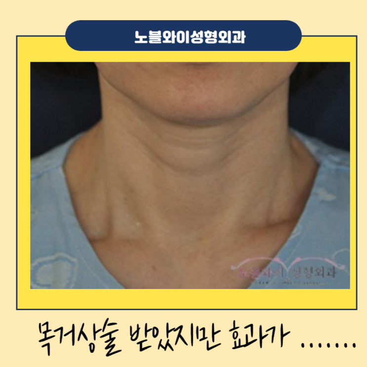 목거상재수술 목주름이 아직도