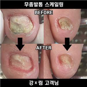 문제성 / 무좀 발 관리 전문샵 송도 페디아이티엔