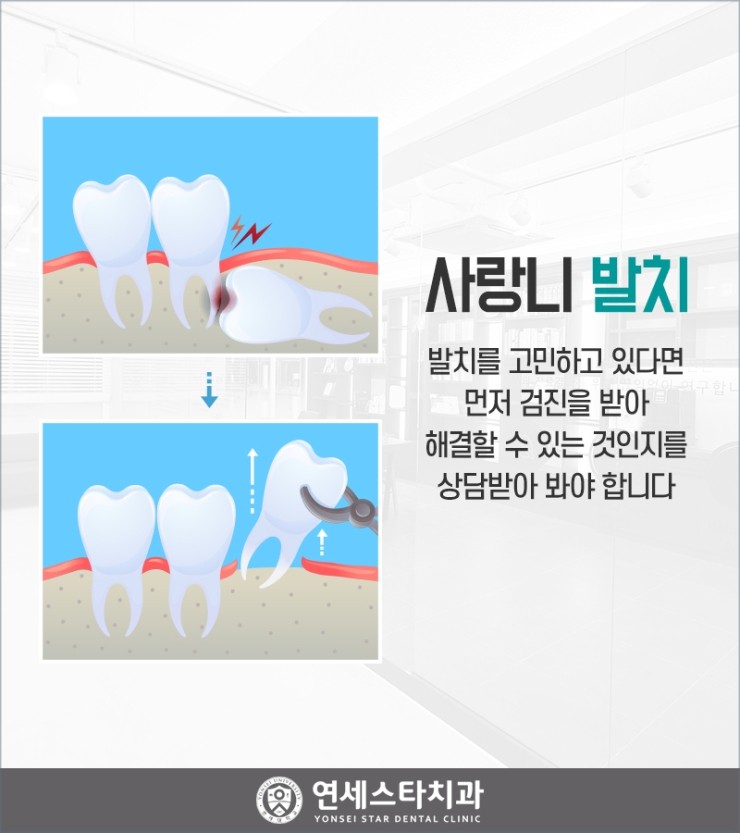 안산사랑니치과 발치 난이도가 높아도 잘하는 곳 2