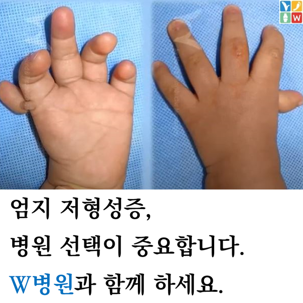  아기 엄지저형성증, 무지저형성증, 단지증, 엄지화 수술 W병원과 함께하세요.